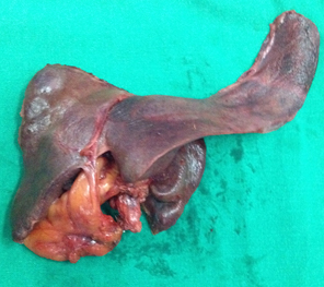 Type 3b resected specimen Type 3b resected specimen