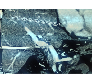 Vascular narrowing of R PV in type 3b Vascular narrowing of R PV in type 3b