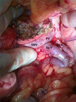 Vessel and Spleen preserving pancreatectomy Vessel and Spleen preserving pancreatectomy